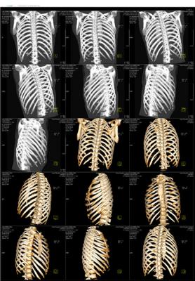醫用ct膠片-黑白胸骨