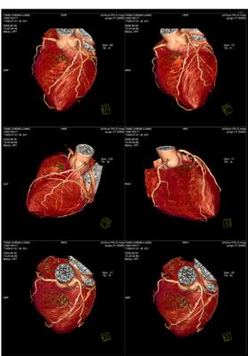 醫用ct膠片-心臟